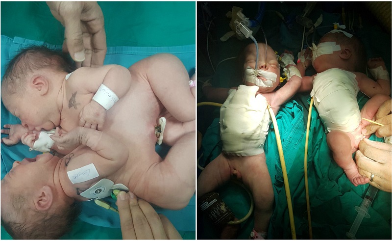 Pediatric Surgeons At Alexandria's Shatby Hospital Successfully Separate Conjoined Twins