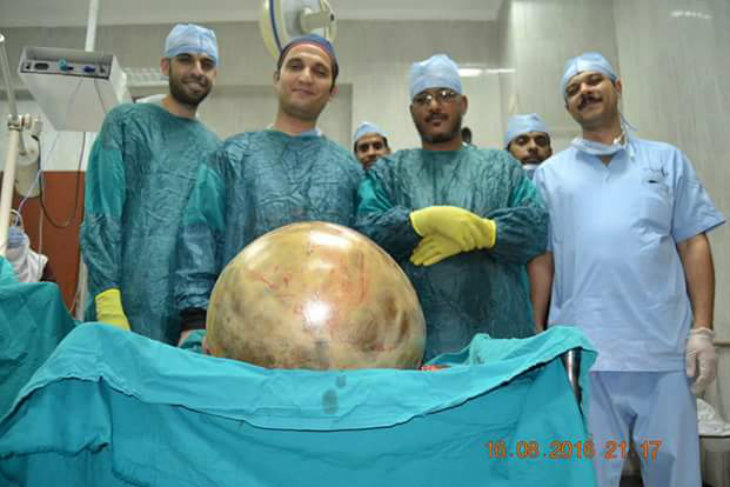 Egyptian Surgeons in Assiut Extract 38 kg Tumour from Woman's Body